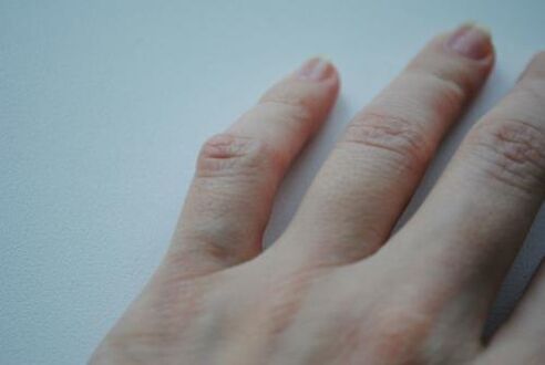 Στο μικρό δάχτυλο εμφανίστηκε ένα αρθριτικό εξόγκωμα. 