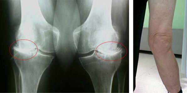 ακτινογραφία οστεοαρθρίτιδας γόνατος
