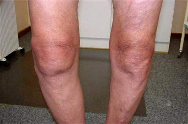 πρησμένο γόνατο λόγω αρθρίτιδας