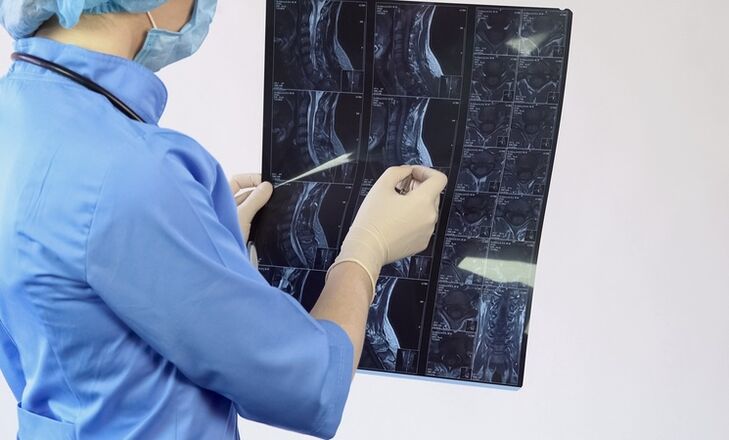 Η διάγνωση της «αυχενικής οστεοχόνδρωσης» γίνεται με βάση μια μαγνητική τομογραφία