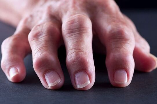 Παραμορφώσεις των αρθρώσεων των δακτύλων λόγω οστεοαρθρίτιδας ή αρθρίτιδας